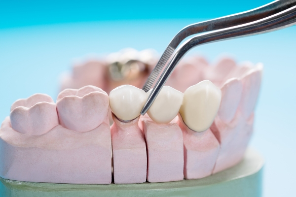 The   Types Of Dental Bridges: What You Should Know