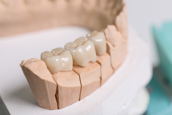 Tooth Replacement Options: An Overview Of Dental Bridges
